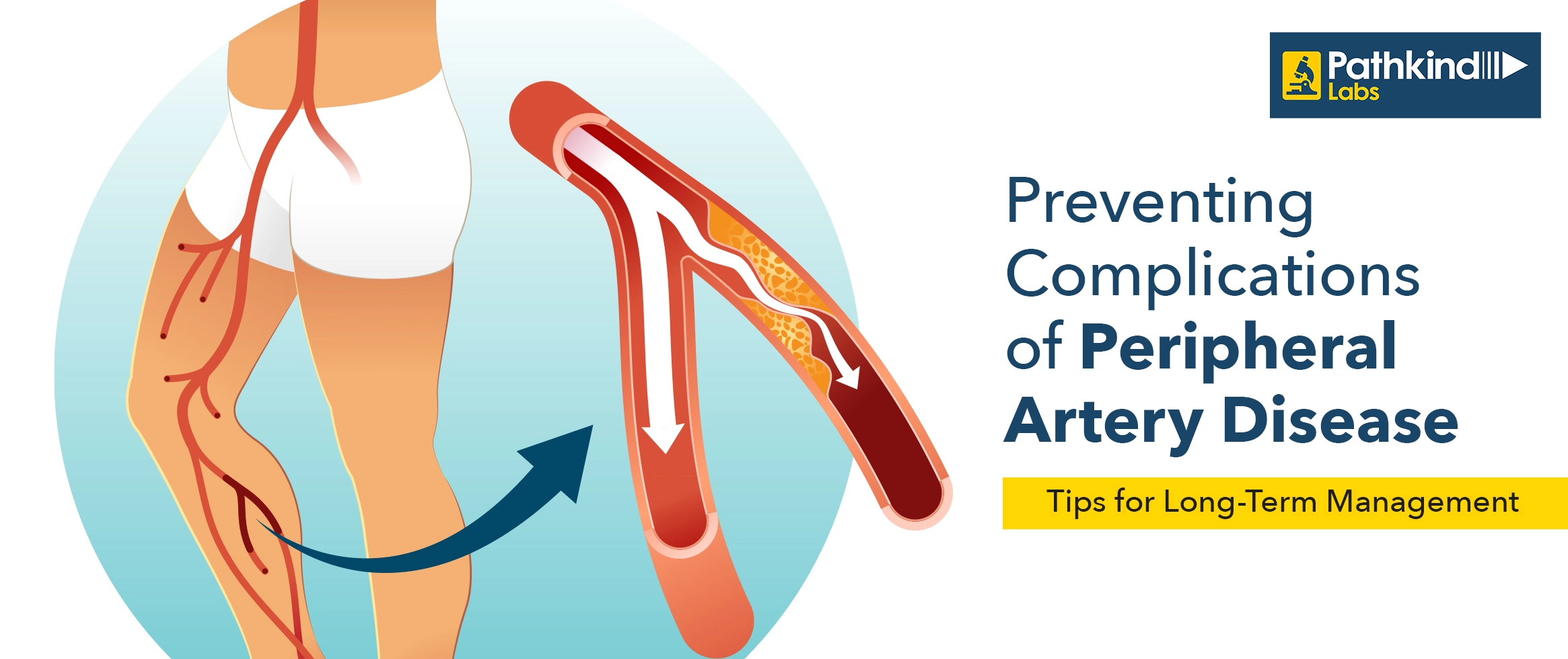 Peripheral Artery Disease